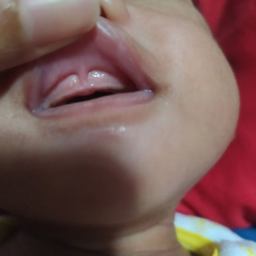 Lip Tie Pada Bayi