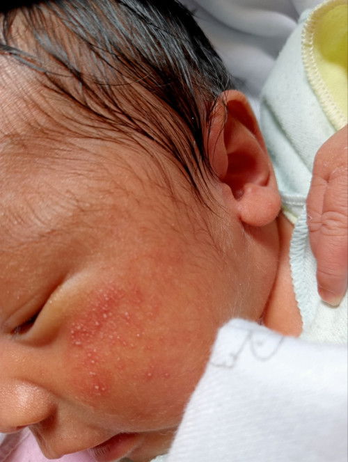 Bruntusan dan ruam pada bayi