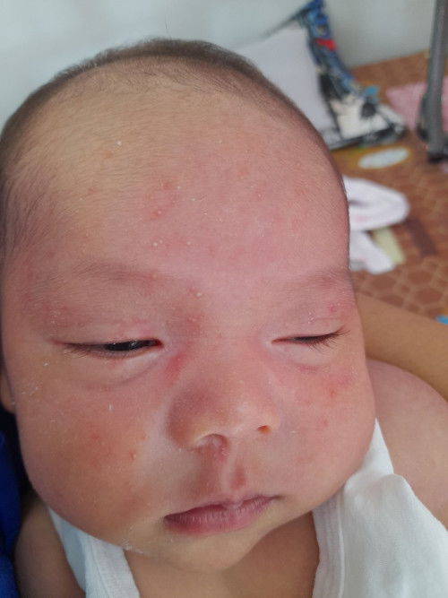 ผดผื่นอยู่หน้าลูก