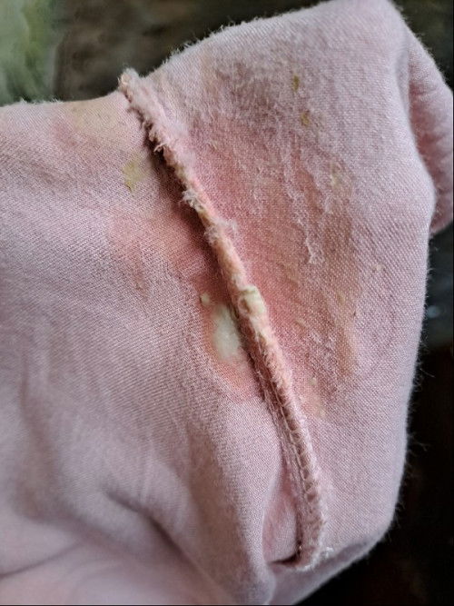 Keputihan normal atau abnormal