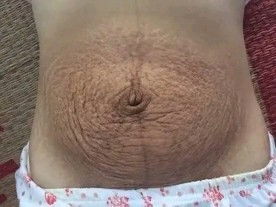 apakah perut yang seperti ini bisa biasa lagi ?