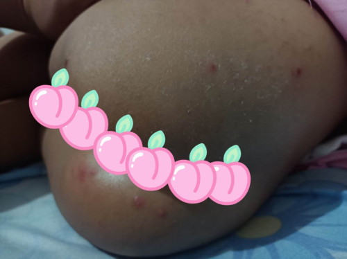 Rashes ba to?