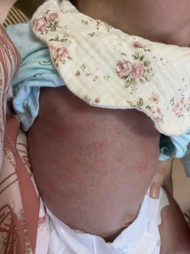 Bé bị nổi như này là bị sao vậy các mẹ