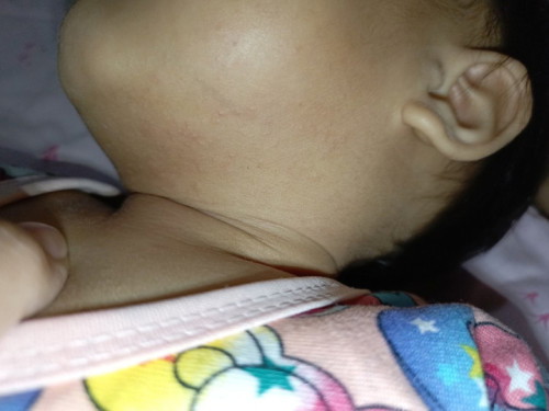 Butlig sa leeg ni baby