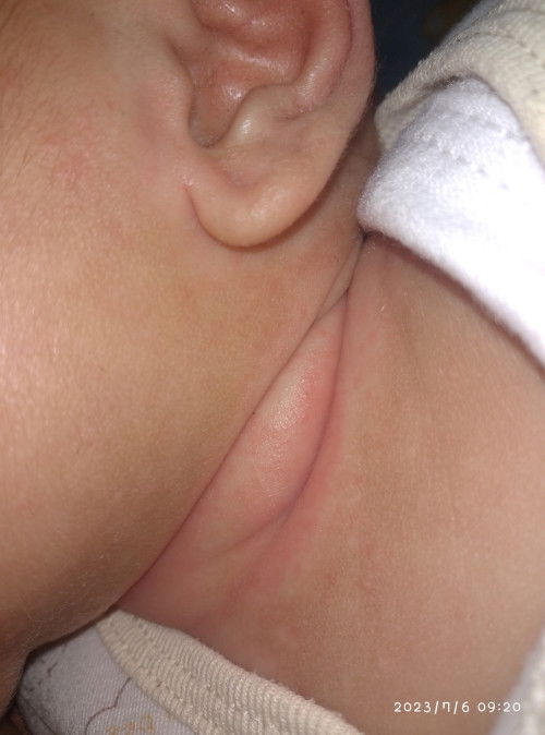 Kemerahan pada bayi umur 2bulan