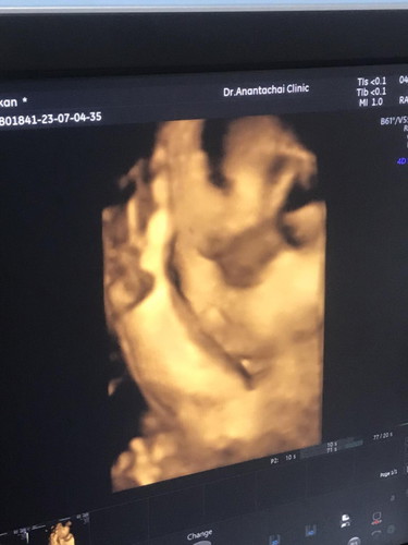 31+2week .
