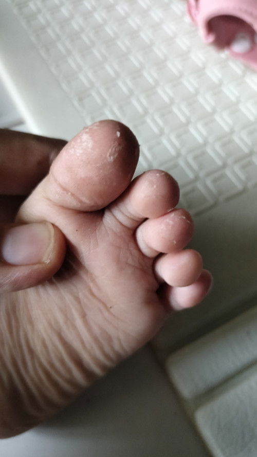 Kulit kaki dan tangan dekat kuku mengelupas