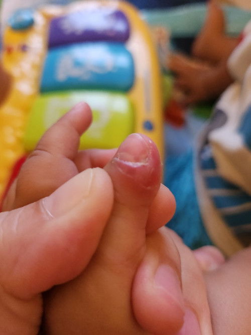 Jari baby bengkak