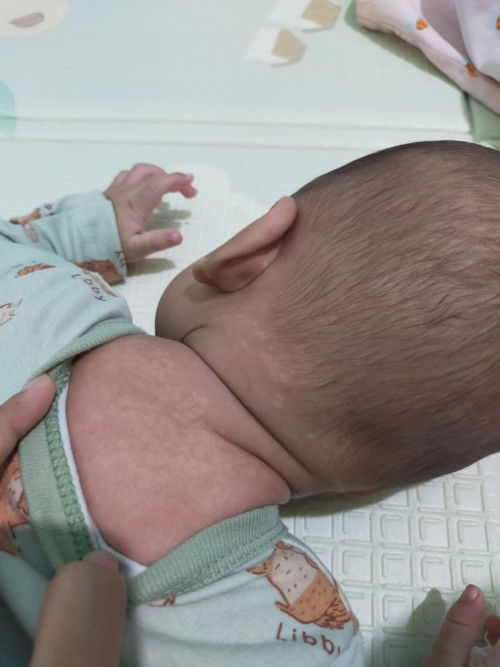 Bercak putih pada bayi