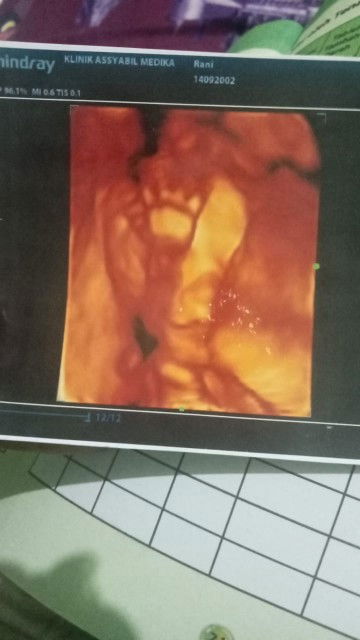 Ada ga bun yg di perkirakan anaknya bibir sumbing