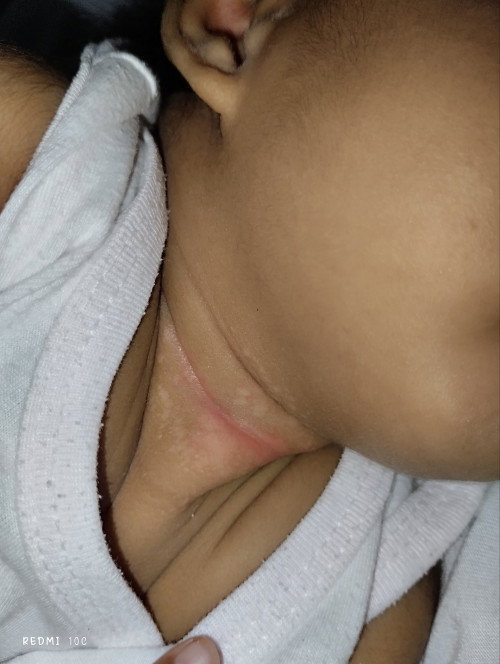 rashes????