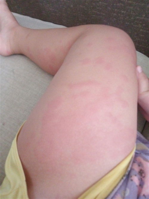 Bé e nay 3 tuổi rưỡi mà qua nay bé nổi như vậy có mom nào biết tình trạng vậy là bị gì kh ạ