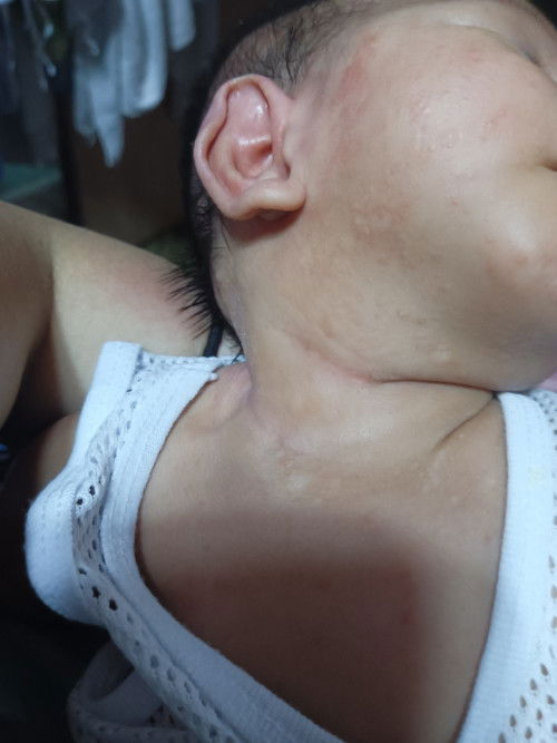 RASHES + PUTI PUTI SA LEEG NI BABY NA DATING RASHES DIN