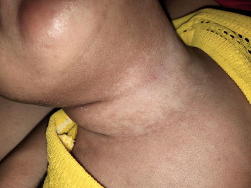 คอน้องเคยเป็นผดผื่นจนลอกเป็นขุยตอนนี้หายแล้วเป็นด่างแบบนี้บำรุงยังไงดีคะ