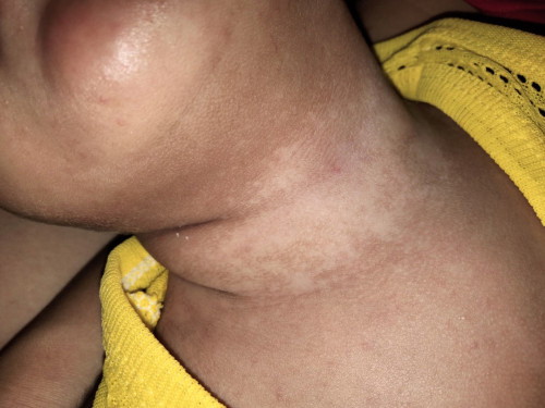 คอน้องเคยเป็นผดผื่นจนลอกเป็นขุยตอนนี้หายแล้วเป็นด่างแบบนี้บำรุงยังไงดีคะ