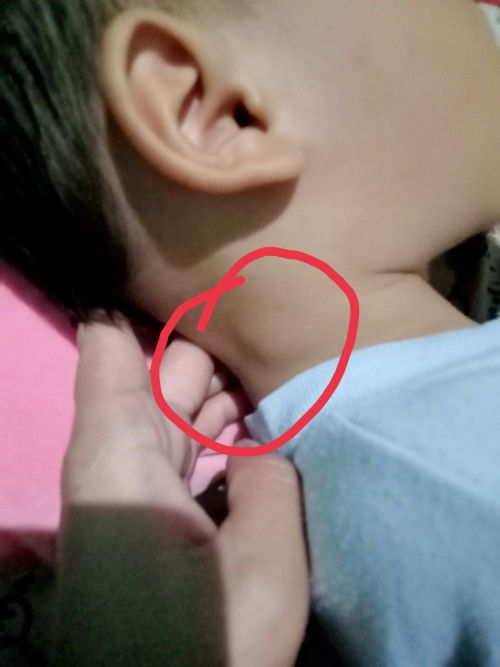 Benjolan di leher anak 2thn