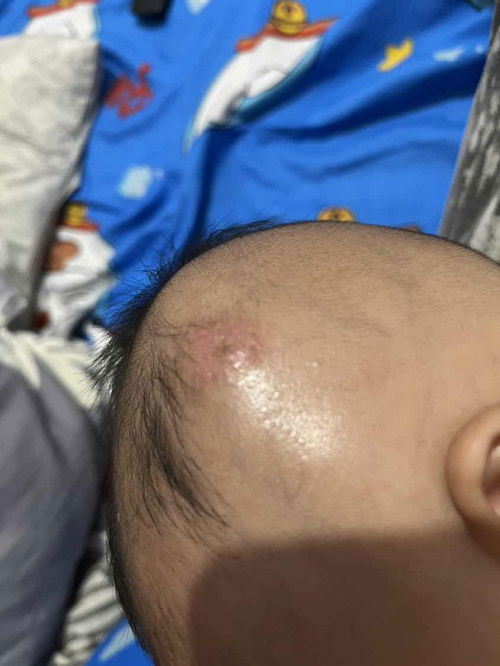 Bund benerkah ini bisul?