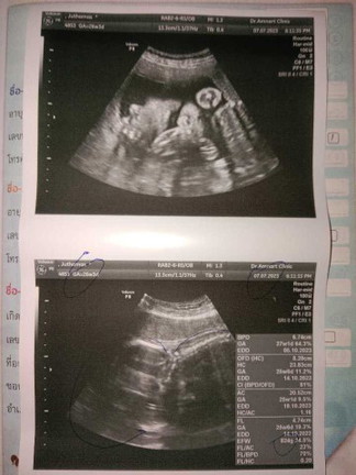 26w 3d ยังไม่ทราบเพศค่ะ