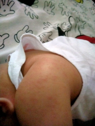 Hi mga mommy bigla nalang po siyang nilabasan ng mga rashes sa buong mukha at sa mga braso