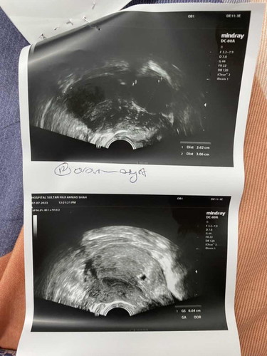 Early Pregnant : Awal Kehamilan Masalah Kantung berada di bawah