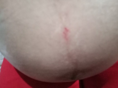 37 wks6 days nagpokpok ako ng pako natalsikan magkakaroon kaya ng defect kay baby?