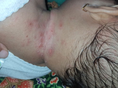 Cacar air atau apa ini ya??