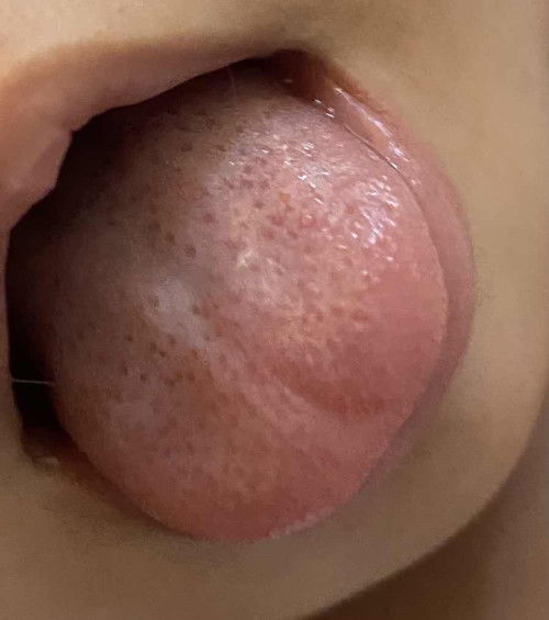 Ada sejak menjak ni suka jelirkan lidah pastu prasan lidah dia mcm ada bintik merah mcm strawberry