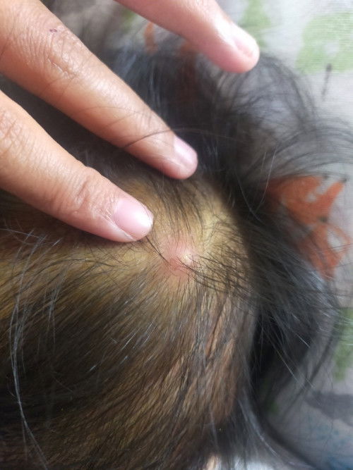 Benjol seperti bisul di kepala bayi 7 bulan