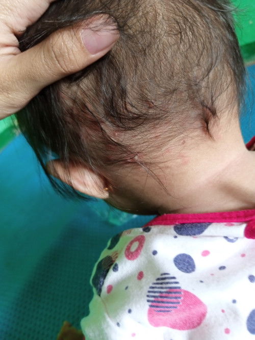 Bun ini Kenapa kepala anak saya ya?2hari lalu masih beberapa bisa kehitung hariini malah makin banya