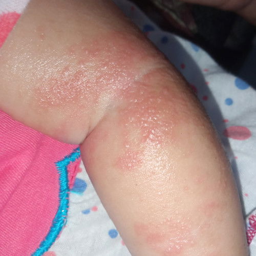 Bintik2 merah pada lengan bayi