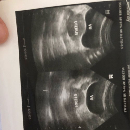 5 minggu usg belum terlihat