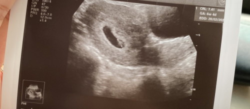 Bentuk kantung (6w4d)