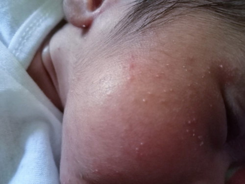 Baby acne Po ba ito or should I consult a pedia na?