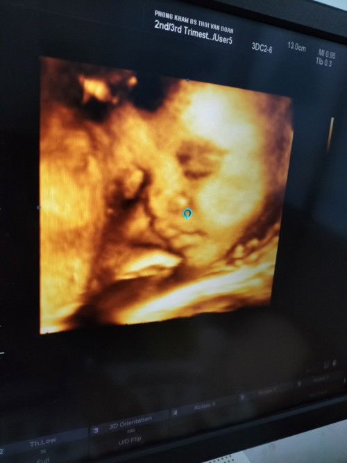 Còn em đc 35m2d bị cuốn dây rốn 1 vòng có s k ạVs cân năng hiện tại là 2kg7 r có lớn k ạ😔