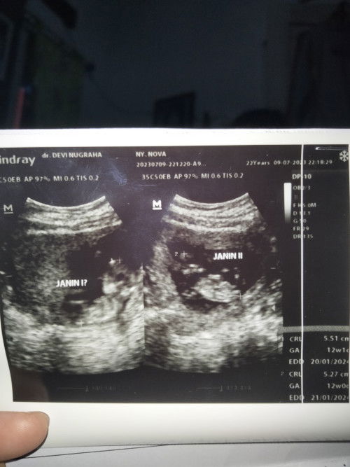 Hamil kembar usia 12w6day