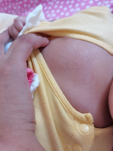 Baby Skin Dryness