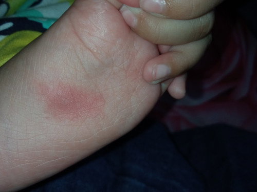 Kaki bayi merah