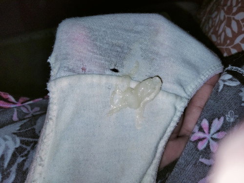 Normal Discharge or Mucus Plug