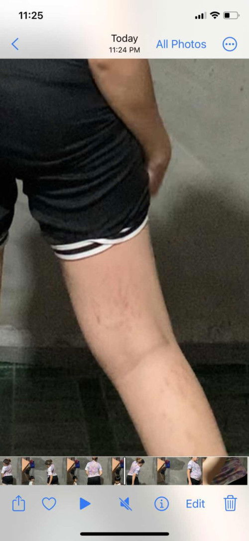 Stretch marks or kamot ba ito?