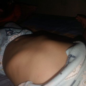 Tulang dada menonjol sebelah kanan