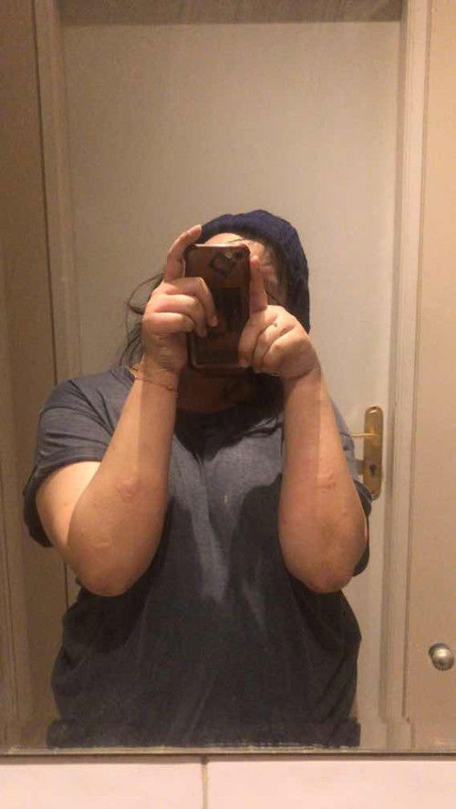 hamil 38 w 2 hari muncul PUPPP