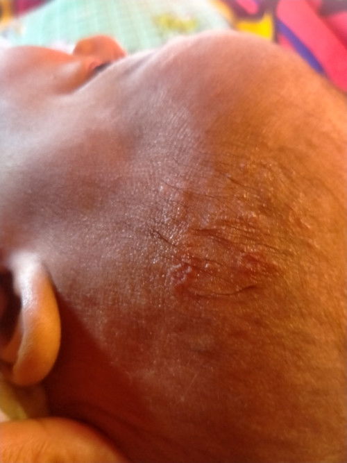 Herpes pada bayi 3 bulan