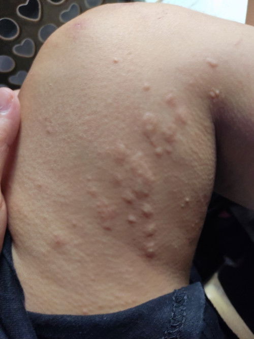 Mga mommy ask ko lang if normal ba ito sa pag bubuntis, sobrang kati at hapdi nya po huhu ☹️