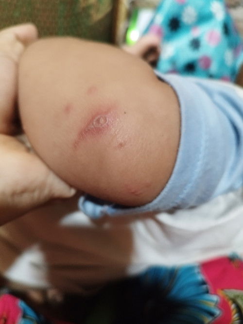 Bentol merah ditengahnya ada air)nanahnya