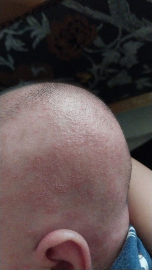 Kepala bayi 3 minggu iritasi