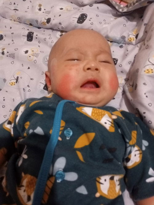 Kemerahan pada bayi 3 bulan