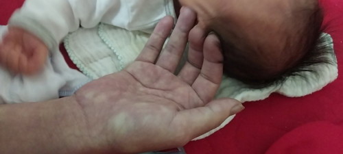 Các mom ơi có mom nào đẻ xong bị sốt rét từng cơn như em kh ạ Ng nóng hổi đắp mấy chăn vẫn rét