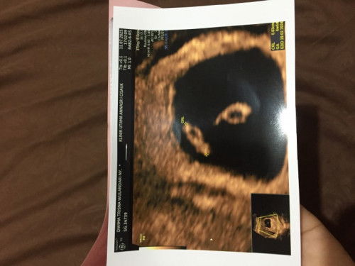 Penebalan rahim kini sudah ada janinnya