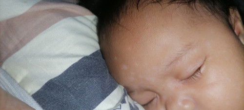 White patches sa mukha