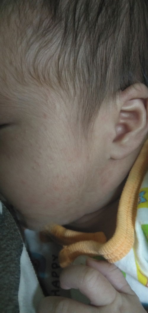 ผื่นลูกเกิดจากสาเหตุอะไร